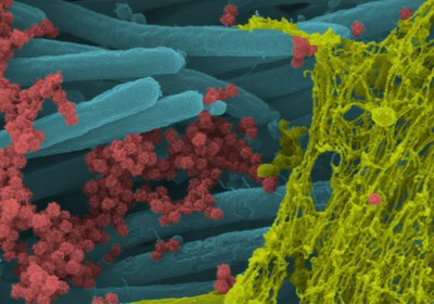 صور "مفزعة" لهيمنة فيروس كورونا على خلايا المصاب