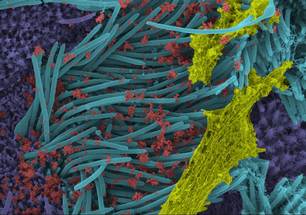 صور "مفزعة" لهيمنة فيروس كورونا على خلايا المصاب